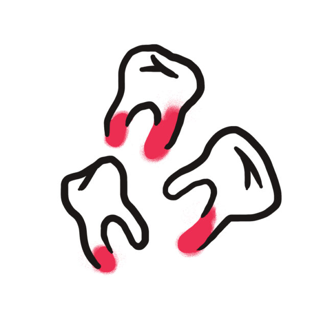 Eine einfache Zeichnung von drei extrahierten Zähnen mit roter Färbung an den Wurzeln, die Blutungen andeuten. Die Zähne sind auf einem einfarbigen weißen Hintergrund in Abständen angeordnet.